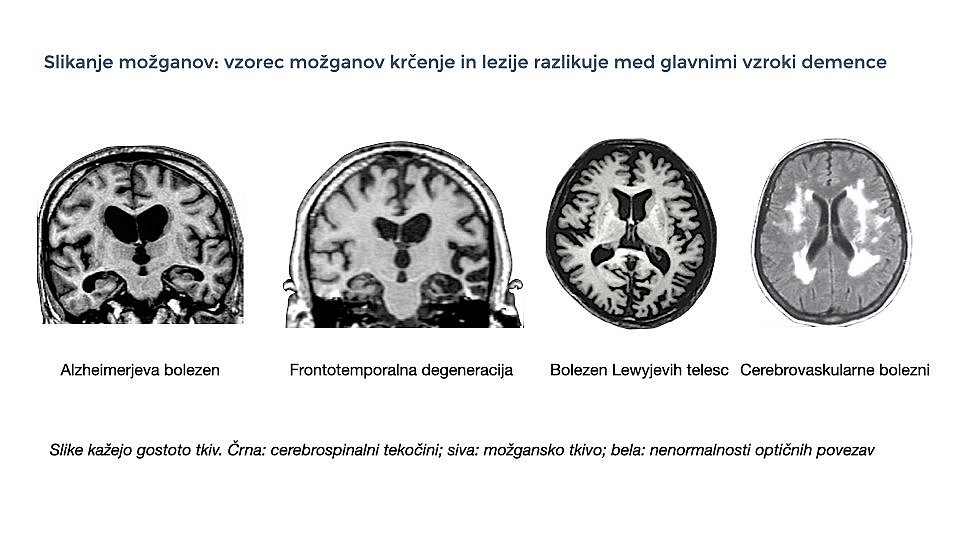 Na sliki so 4 slike s tipičnimi izvidi MRI pri Alzheimerjevi bolezni, frontotemporalni degeneraciji, Bolezni Lewyjevih telesc in cerebrovaskularni bolezni.