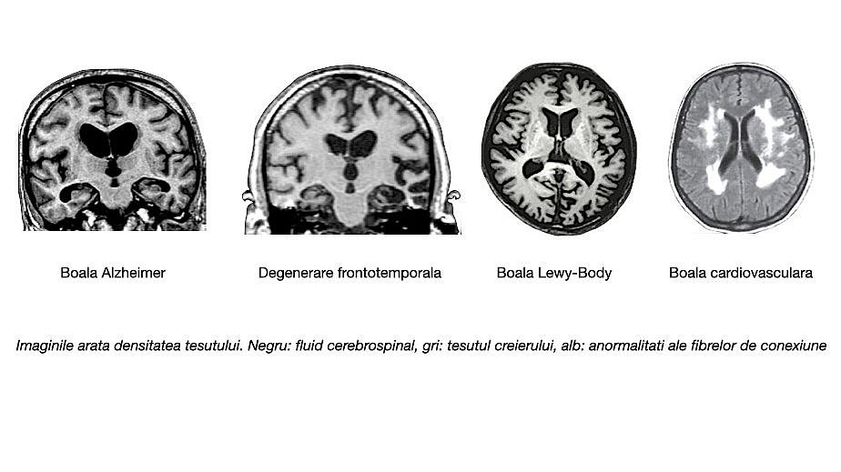 Imaginea prezintă 4 imagini cu constatări tipice RMN în boala Alzheimer, demență frontotemporală, demență cu corpi  Lewy și boala cerebrovasculară.