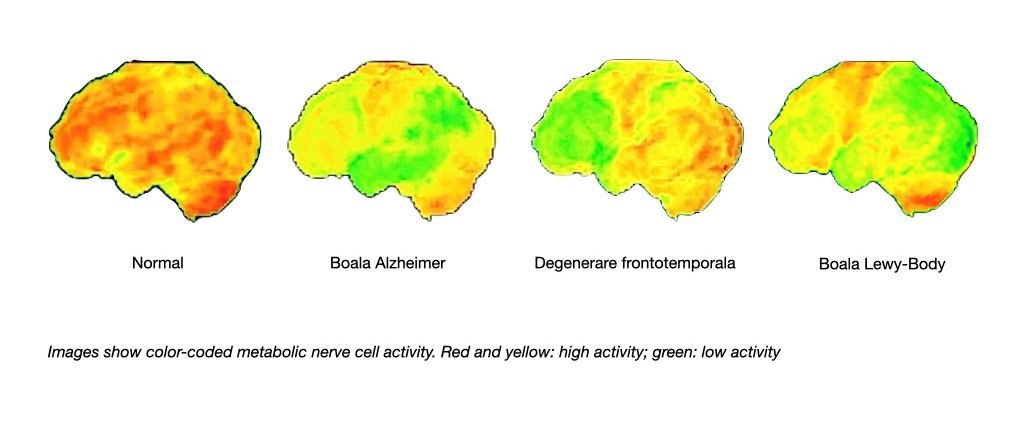 Aceste imagini arată rezultatele tipice ale tomografiei cu emisie de pozitroni în boala Alzheimer, demență frontotemporală și  cu corpi Lewy, comparativ cu o constatare normală.