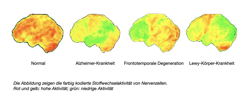 Diese Abbildungen beschreiben typische Befunde der Positronen-Emissions-Tomografie bei Alzheimer-Krankheit, Frontotemporaler Degeneration und Lewy-Körper-Krankheit im Vergleich mit einem Normalbefund.