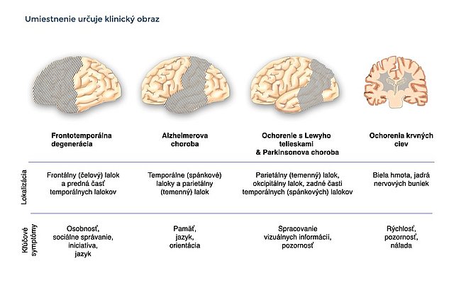 Lokalizácia určuje klinický obraz: Tento graf zobrazuje bočné pohľady na mozgovú hmotu s lokalizáciou dôležitých foriem demencie a hlavných príznakov.  Frontotemporálne degenerácie: Čelný lalok a predná časť spánkového laloku spojené so zmenami osobnosti, sociálneho správania, pohonu a jazyka.  Alzheimerova choroba: spánkový a temenný lalok spojený so zmenami pamäti, jazyka a orientácie. Lewyho telieska a Parkinsonova choroba: temenný lalok, okcipitálny lalok a zadná časť spánkového laloku spojené so zmenami v spracovaní vizuálnych informácií a pozornosti.  Cerebrovaskulárne ochorenia: Biela hmota (medulárna) a hlboké jadrá nervových buniek spojené so zmenami tempa, pozornosti a nálady.