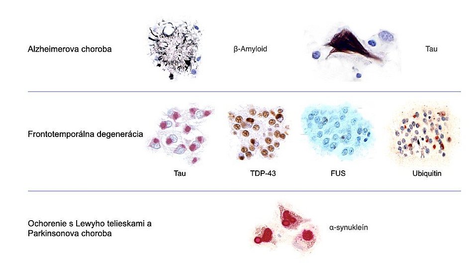 Ukladanie proteínov pri neurodegeneráciách: Na obrázku sú zobrazené bielkovinové ložiská na mikroskopických snímkach plakov (amyloid), neurofibrilových zmien (tau), Lewyho teliesok (α-synukleín) a ložiská iných proteínov (TDP-43, FUS, ubikvitín) v nervových bunkách.