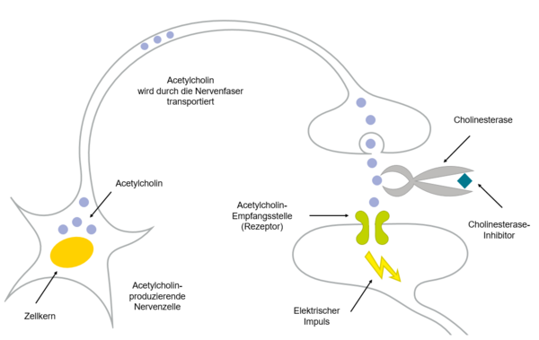 Diese Grafik beschreibt die Wirkungsweise von Cholinesterase-Inhibitoren. Der Überträgerstoff Acetylcholin wird von einer Nervenzelle zur nachgeschalteten Nervenzelle durch den synaptischen Spalt weitergegeben. Im synaptischen Spalt wird der Überträgerstoff durch ein Enzym (Cholinesterase) gespalten. Dieses Enzym wird durch Cholinesterase-Inhibitoren gehemmt, so dass mehr Überträgerstoff weitergegeben werden kann.