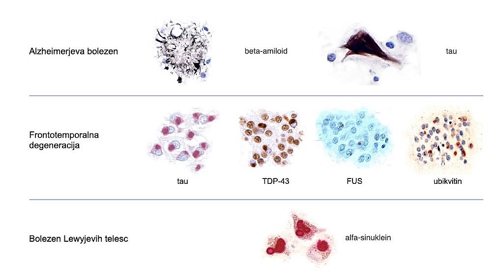 Razvoj patologije Alzheimerjeve bolezni v možganih: črtni diagram kaže, da sta pri Alzheimerjevi bolezni predsimptomatska in prodromalna stopnja pred stopnjo demence. Kognitivna zmogljivost začne upadati šele v prodromalni fazi.