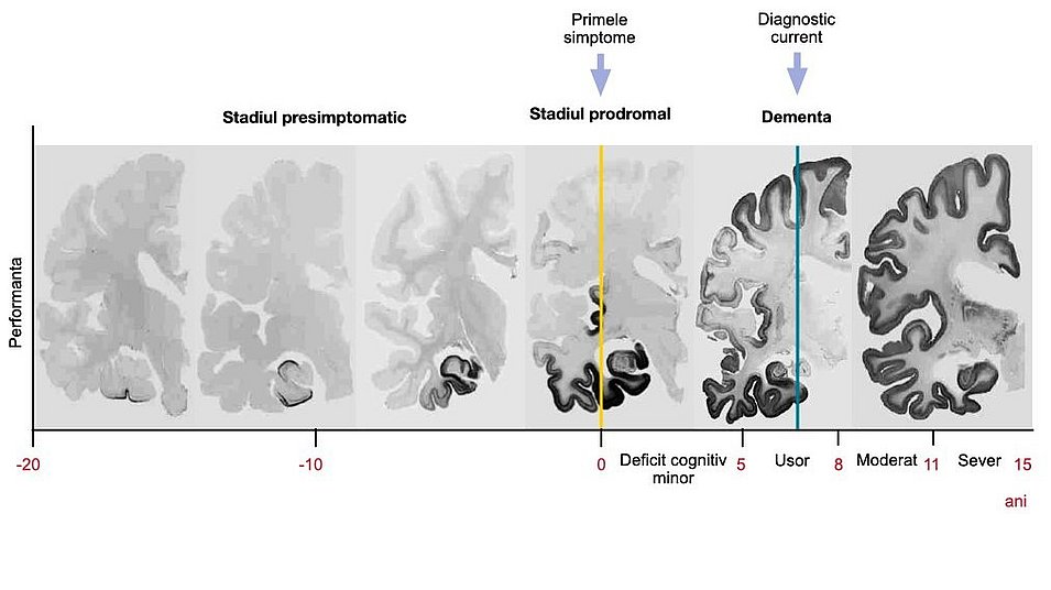 Evoluția patologiei bolii Alzheimer în creier: O diagramă liniară arată că în boala Alzheimer, o etapă pre-simptomatică și o etapă prodromală preced stadiul de demență. Performanța cognitivă începe să scadă doar în stadiul prodromal.