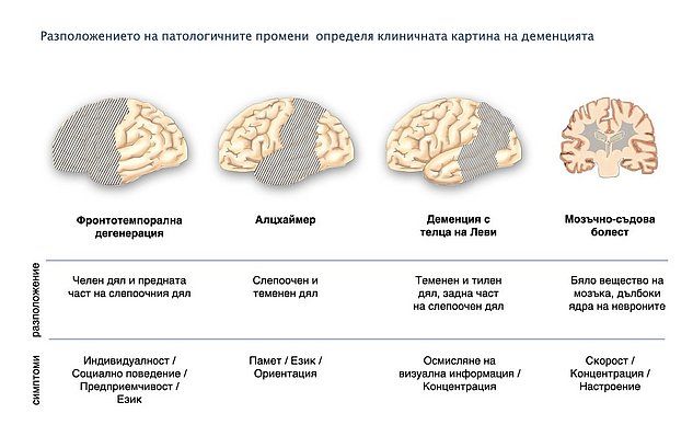 Локализацията определя клиничната картина. Тази илюстрация показва мозъка, погледнат отстрани с типичната локализация на типичните форми на деменция и техните основни симптоми. Фронтотемпорална дегенерация - увредите в челните дялове и предните отдели на слепоочните дялове са свързани с промени в личността, социалното поведение, мотивацията и езика. При болестта на Алцхаймер - увредите в слепоочните и теменнте дялове са свързани с промени в пеметта, езика и ориентацията. При деменцията с телца на Леви и болестта на Паркинсон  - увредите в теменните, тилните и задните отдели на слепоочните дялове са свързани с промени в зрителното възприятие и вниманието. При мозъчно-съдовата болест - увредите в бялото мозъчно вещество и подкоровите сиви ядра са свързани с промени в бързината, вниманието и настроението.