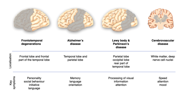 Localisation determines the clinical picture: This graphic shows the lateral views of brain’s surface with localisation of important forms of dementia and main symptoms.  Frontotemporal degenerations: Frontal lobe and anterior portion of temporal lobe associated with changes in personality, social behaviour, drive and language.  Alzheimer's disease: temporal and parietal lobes associated with changes in memory, language and orientation.  Lewy body and Parkinson's disease: parietal lobe, occipital lobe and posterior part of temporal lobe associated with changes in processing of visual information and attention.  Cerebrovascular diseases: White matter (medullary) and deep nerve cell nuclei associated with changes in tempo, attention and mood. 