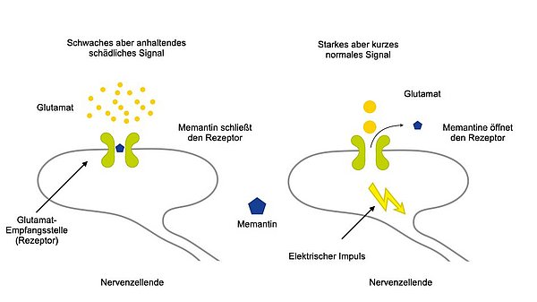 Diese Grafik beschreibt die Wirkungsweise von Memantin. Der Überträgerstoff Glutamat wird normalerweise in der Form von kurzen Impulsen zur nachgeschalteten Nervenzelle weitergeleitet. In diesem Fall öffnet Memantin die für Glutamat zuständige Empfangsstelle (Rezeptor). Bei der Alzheimer-Krankheit wird Glutamat aus untergehenden Nervenzellen fortlaufend freigesetzt. In diesem Fall verschließt Memantin die Empfangsstelle und schützt so die nachgeschaltete Zelle vor einer Dauer-Erregung. 