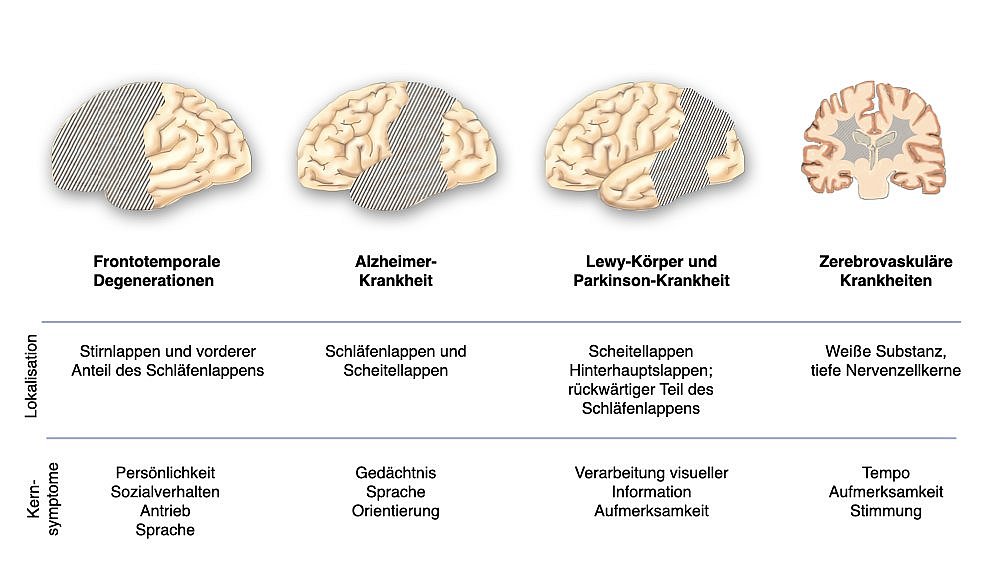 Die Lokalisation bestimmt das klinische Bild: Diese Grafik zeigt die seitlichen Ansichten der Oberfläche des Gehirns mit Lokalisation wichtiger Demenzformen und Hauptsymptomen.  Frontotemporale Degenerationen: Stirnlappen und vorderer Anteil des Schläfenlappens assoziiert mit Veränderungen von Persönlichkeit, Sozialverhalten, Antrieb und Sprache.  Alzheimer-Krankheit: Schläfenlappen und Scheitellappen assoziiert mit Veränderungen von Gedächtnis, Sprache und Orientierung.  Lewy-Körper- und Parkinson-Krankheit: Scheitellappen, Hinterhauptslappen und rückwärtiger Teil des Schläfenlappens assoziiert mit Veränderungen der Verarbeitung visueller Information und der Aufmerksamkeit.  Zerebrovaskuläre Krankheiten: Weiße Substanz (Marklager) und tiefe Nervenzellkerne assoziiert mit Veränderungen von Tempo, Aufmerksamkeit und Stimmung. 