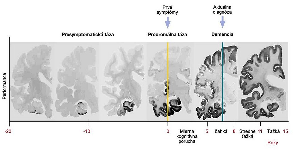 Ilustrácia s rezmi mozgu popisujúcimi nasledujúce skutočnosti: Patológia dlho predchádza príznakom. Pri Alzheimerovej chorobe sa neurofibrilárne zmeny začínajú v presymptomatickom štádiu, ale sú obmedzené na časti spánkového laloku. V prodromálnom štádiu sa rozšíria na celý spánkový lalok. V štádiu demencie sú postihnuté veľké časti mozgovej kôry.