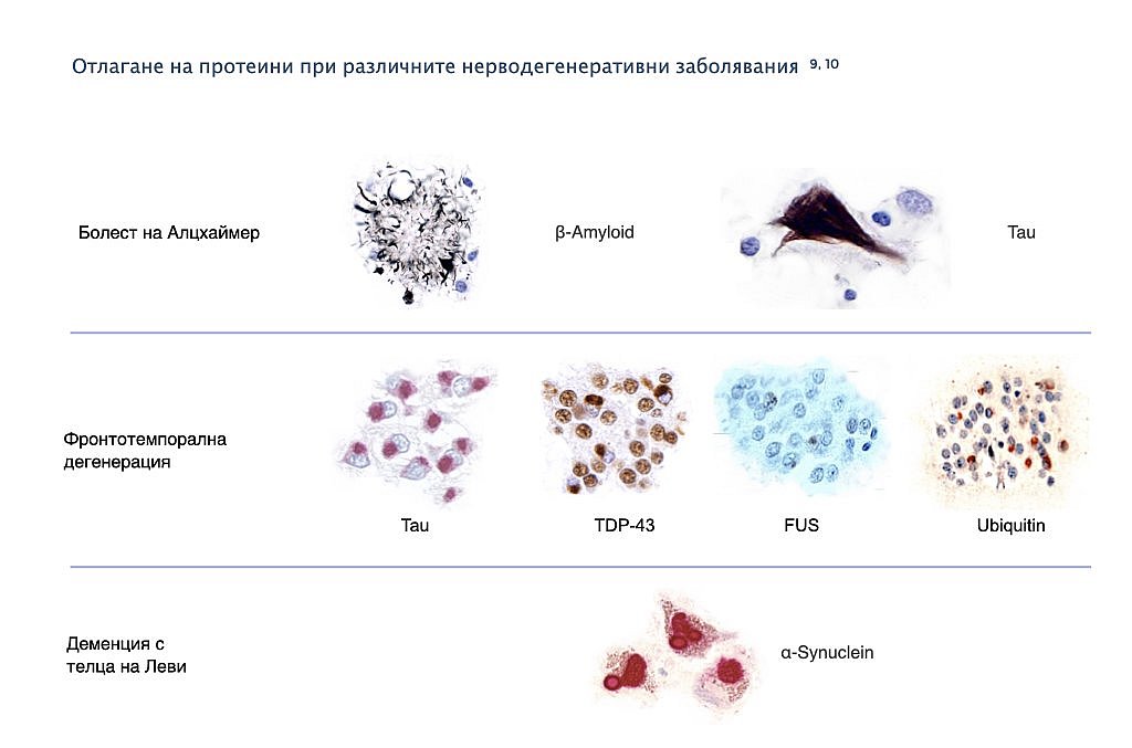 Отлагане на "лоши" белтъци при невродегенеративния процес. Илюстрацията показва протеинови отлагания на микроскопски изображения на плаки (амилоид), неврофибриларни промени (тау), телца на Леви (синуклеин) и отлагания на други протеини (TDP-43, FUS, убикуитин) в невроните.