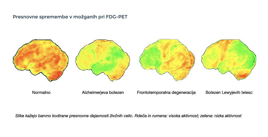 Te slike prikazujejo tipične izvide pozitronske emisijske tomografije (PET) pri Alzheimerjevi bolezni, frontotemporalni degeneraciji in bolezni Lewyjevih telesc v primerjavi z običajnimi izvidi.
