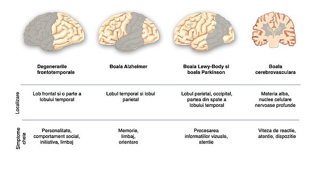 Localizarea determină tabloul clinic: Acest grafic prezintă vederi laterale ale suprafeței creierului cu localizarea formelor importante de demență și a principalelor simptome.  Degenerări frontotemporale: lobul frontal și porțiunea anterioară a lobului temporal asociate cu modificări ale personalității, comportamentului social, impulsului și limbajului.  Boala Alzheimer: lobii temporali și parietali asociați cu modificări ale memoriei, limbajului și orientării.  Corpul Lewy și boala Parkinson: lobul parietal, lobul occipital și partea posterioară a lobului temporal asociate cu modificări în procesarea informațiilor vizuale și a atenției.  Boli cerebrovasculare: Substanța albă (medulară) și nucleele profunde ale celulelor nervoase asociate cu modificări ale tempo-ului, atenției și dispoziției.