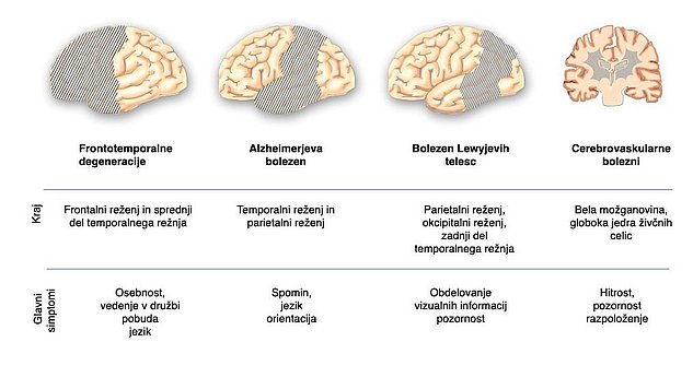 Lokalizacija določa klinično sliko: Ta slika prikazuje stranski pogled na površino možganov z lokalizacijo pomembnih oblik demence in glavnih simptomov. Frontotemporalne degeneracije: čelni reženj in sprednji del temporalnega režnja, povezana sta s spremembami v osebnosti, družbenem vedenju, nagonu in jeziku. Alzheimerjeva bolezen: temporalni in parietalni reženj, povezana sta s spremembami spomina, jezika in orientacije. Bolezen Lewyjevih telesc in Parkinsonova bolezen: parietalni reženj, okcipitalni reženj in posteriorni del temporalnega režnja, povezani so s spremembami v obdelavi vizualnih informacij in pozornosti. Cerebrovaskularne bolezni: bela snov (medularno) in jedra globokih živčnih celic, povezani so s spremembami tempa, pozornosti in razpoloženja.